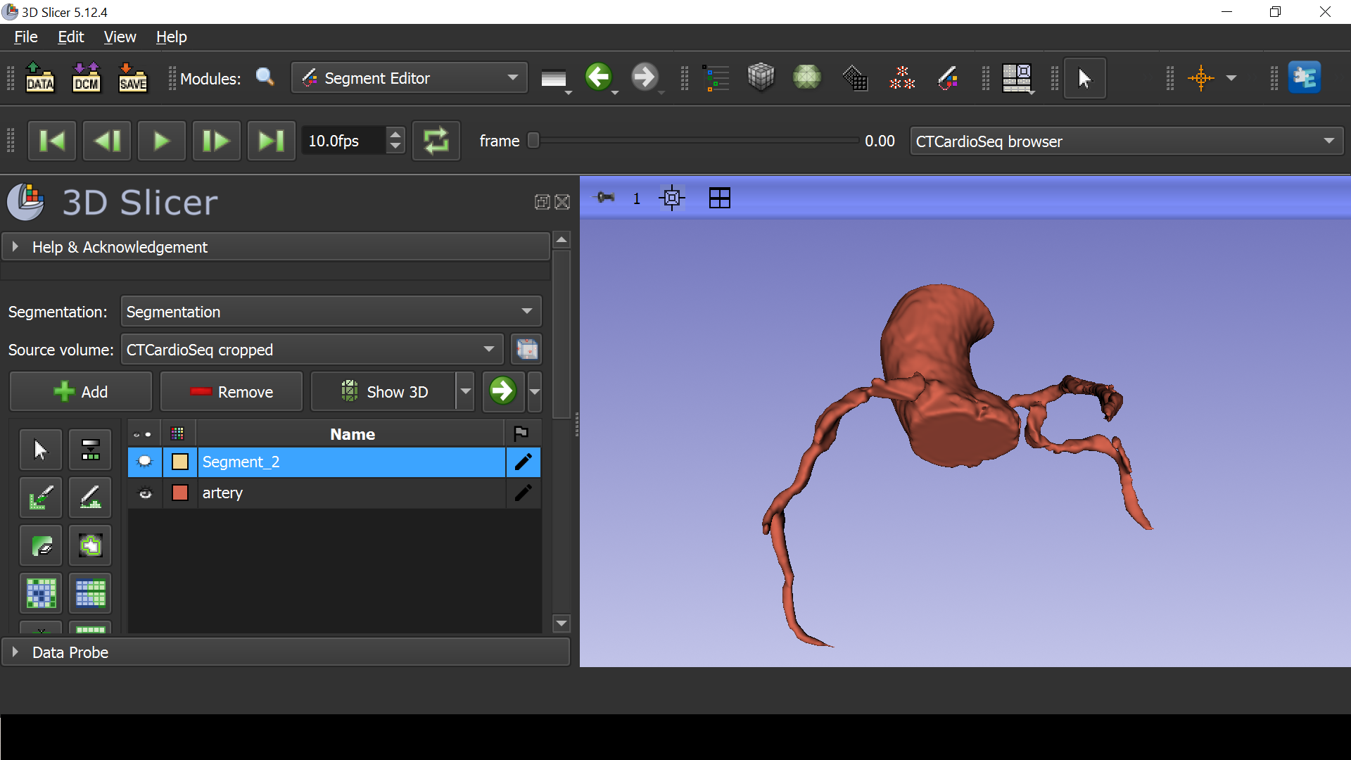 Model 3D naczyń wieńcowych